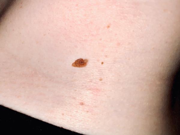 Zmenilo sa mi znamienko na krku