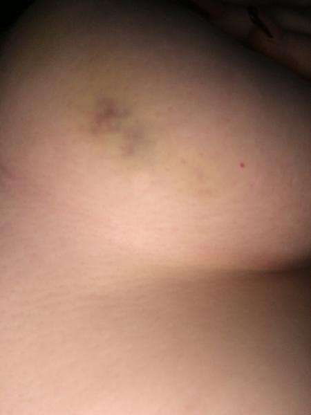 Ako liečiť modrinu na prsníku po uštípnutí?