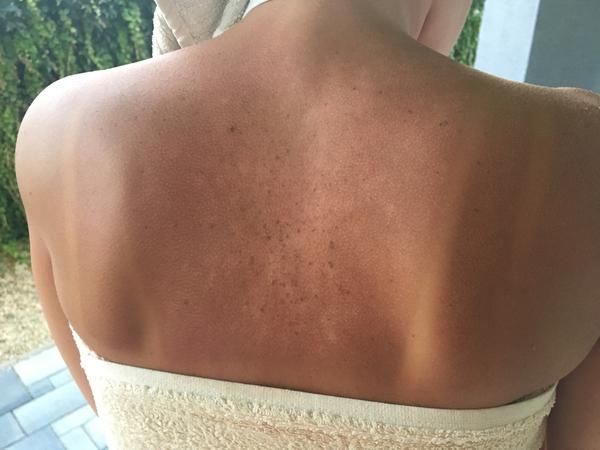 Pred mesiacom som sa hrozne spálila a takto to vyzerá