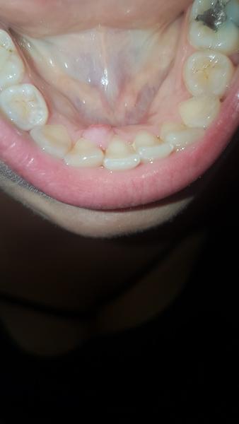 Výrastok v ústach. Rastie, pobolieva, stráca sa a zmenšuje. Čo to je?