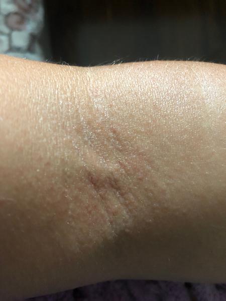 Vyrážky a svrbenie v záhyboch