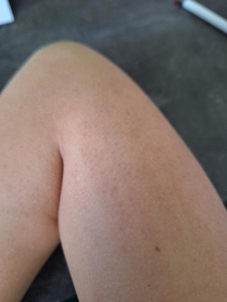 Čo môže byť na mojej ruke?