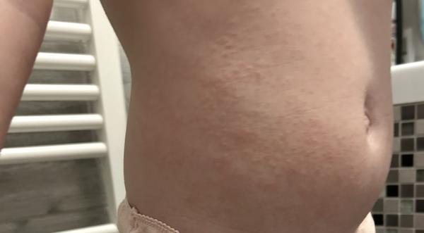 Môže med u detí spôsobiť červené fľaky na brušku?