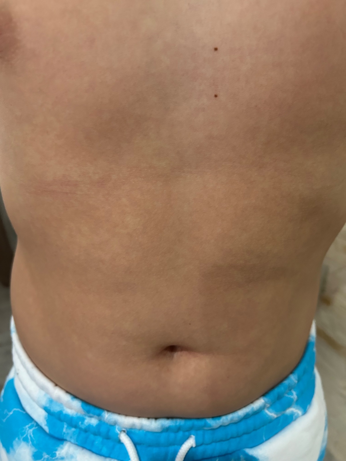 Je to piata choroba alebo osýpky? Modrý koník