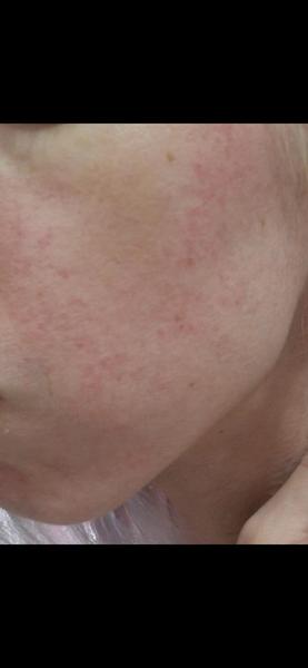 Je to rosacea alebo iné kožné ochorenie?