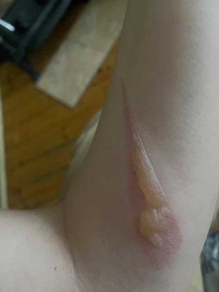 Ako sa umyť s popáleninou?