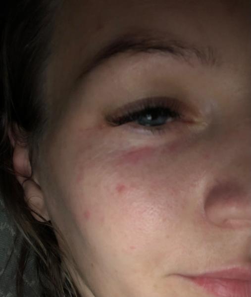 Fľaky na tvári z jedla