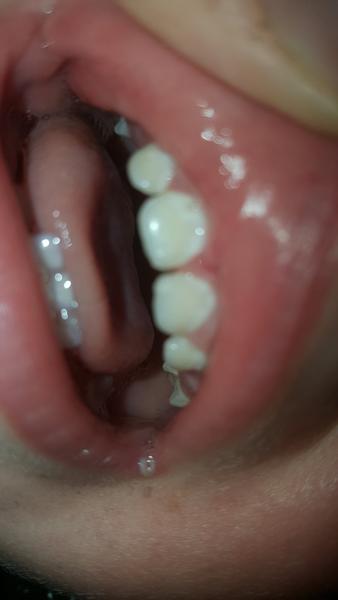 Biele pásiky na zúbkoch 1,5 ročného chlapca