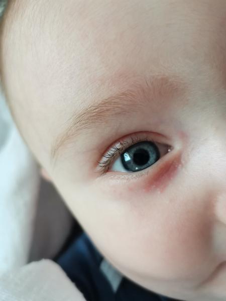 Pupáčiky pod okom a na viečku 7 mesačného synčeka