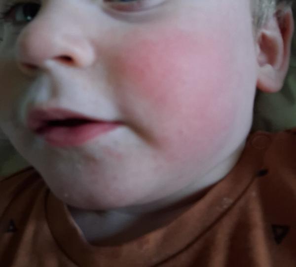 Suché červené líčka u bábätiek. Aký krém pomôže?