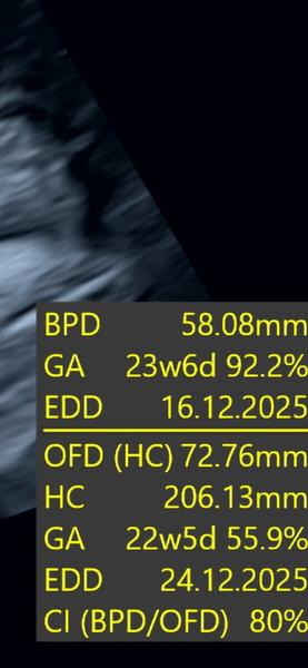 Prečo sú dátumy na ultrazvuku rozdielne?