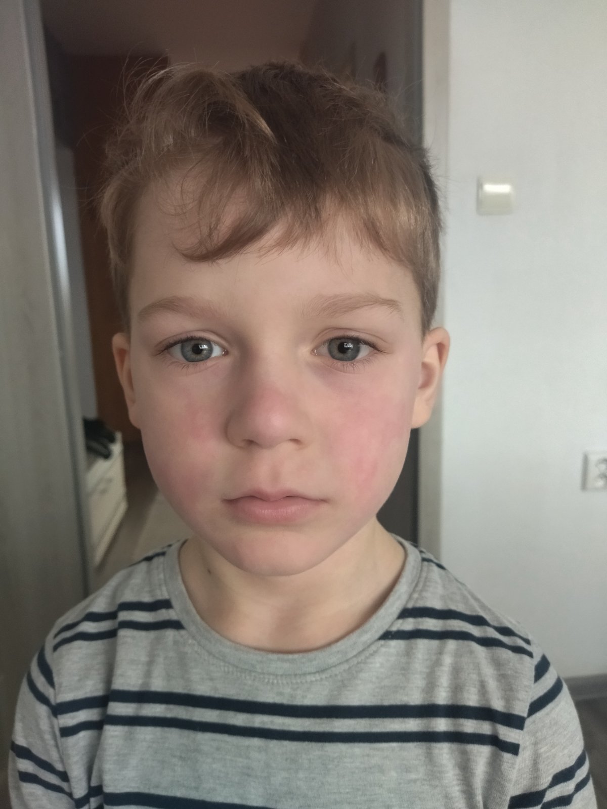 Červené fľaky na tvári. Môže to byť piata choroba? Modrý koník