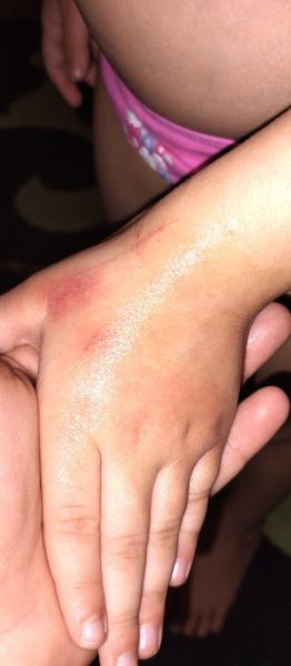 Čo spôsobuje červené fľaky na rukách?