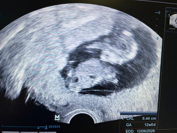 Odhad pohlavia bábätka pomocou chat GPT