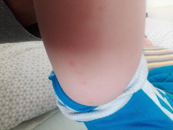 Čo sú to za vyrážky na synových nohách?