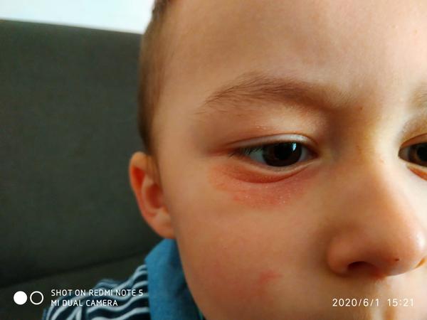 Ako liečiť ekzém u skoro trojročného dieťaťa?