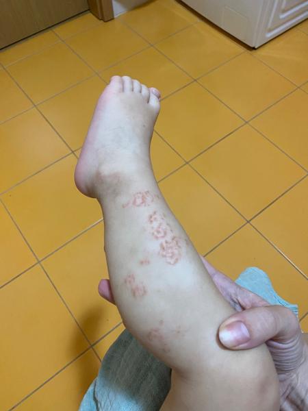 Ako riešiť suché miesta a chrasty na nohách?