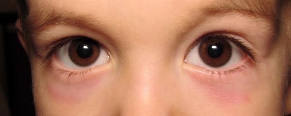 Čo znamenajú podliate oči?