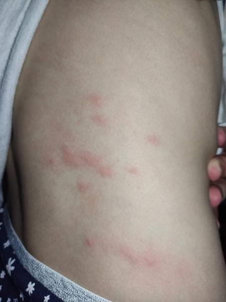 Aké vyrážky má moja dcérka?