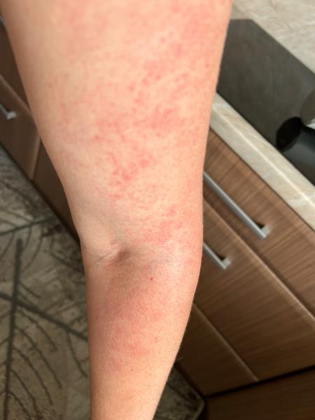 Po pôrode som sa vyhádzala. Môže sa takto prejavovať alergia?