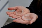 Aké máte skúsenosti s výmenou dlahy pri Invisalign strojčeku?