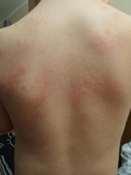 Atopický ekzém u skoro trojročného