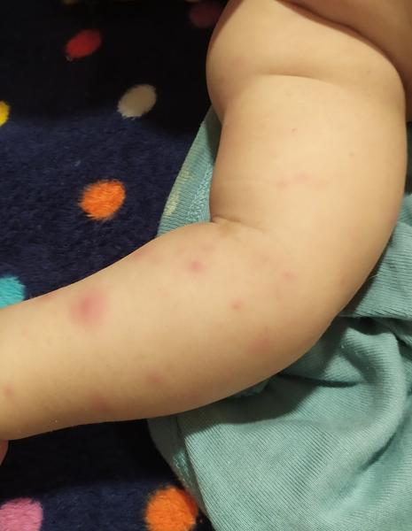 Čo sú toto za vyrážky?