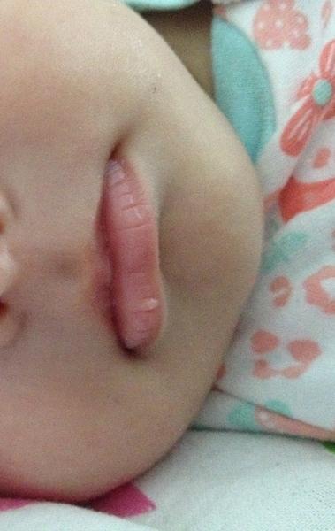 Biely výrastok na spodnej pere od narodenia. Čo to je?