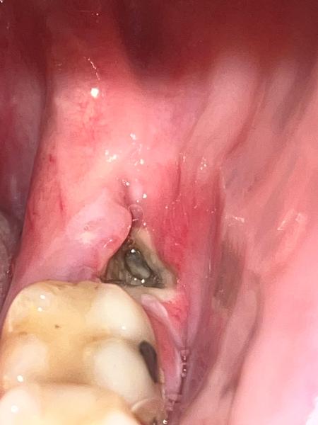 Hojí sa rana po vytrhnutí osmičky správne?