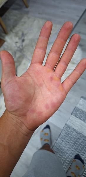 Svrbivé vyrážky na dlaniach: Čo to môže byť?