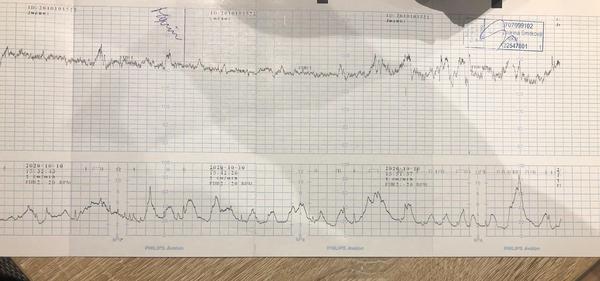 Je tvrdnutie brucha v 33. týždni v poriadku?