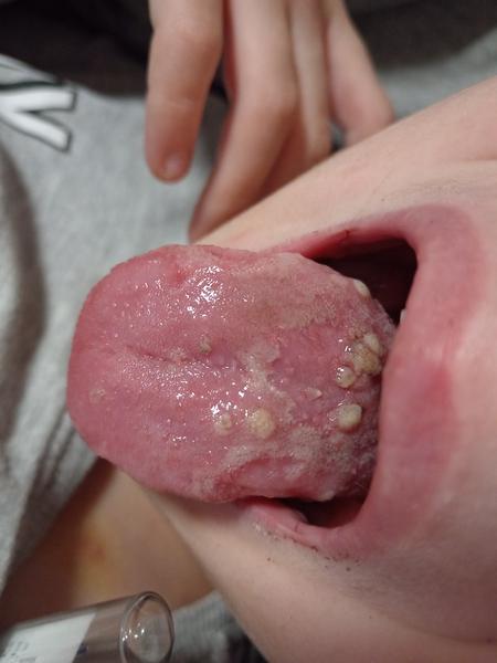 Skúsenosti s kiahňami na jazyku u detí?