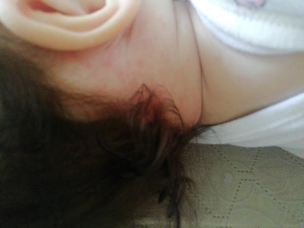 Čo sú tieto vyrážky?