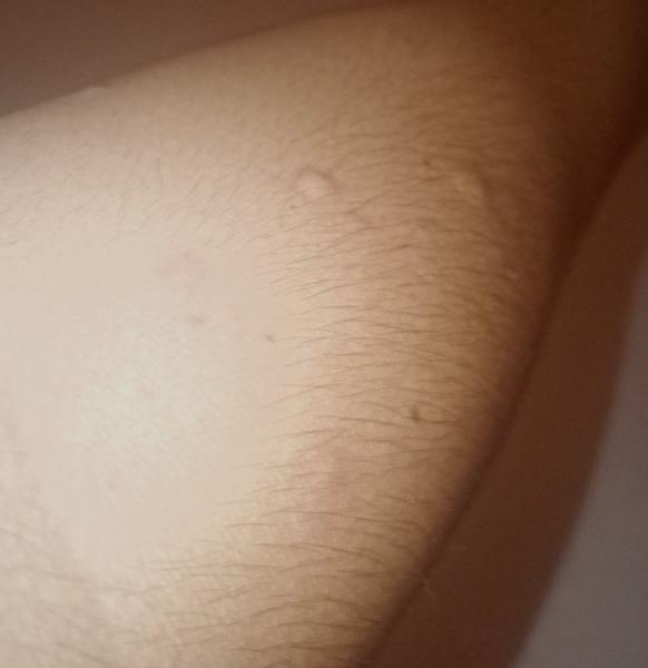 Čo spôsobuje červené a svrbiace vyrážky na tele?