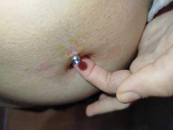 Piercing ma bolí po troch týždňoch nosenia