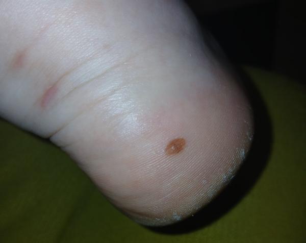 Môže byť podozrivý nález na päte melanóm?