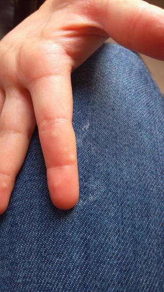 Vyrážky na prstoch rúk