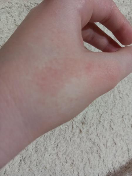 Čo znamenajú červené vyrážky na ruke?