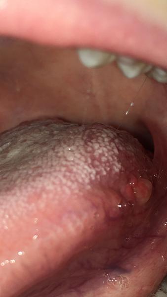 Na jazyku sa mi objavili hrudky. O aký problém môže ísť?