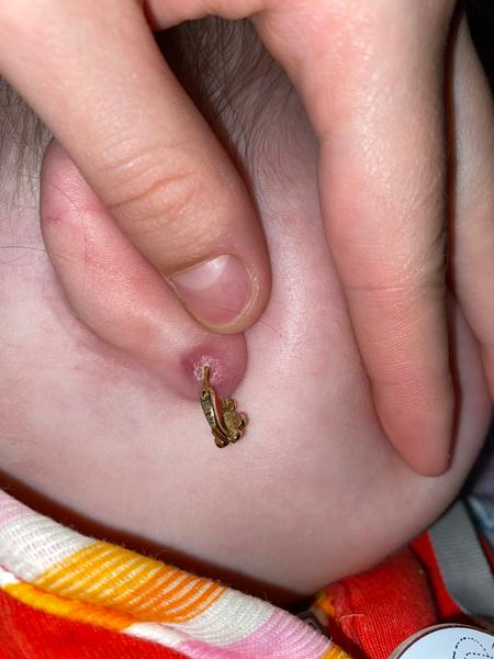 Ako liečiť zapálenú dierku v uchu?