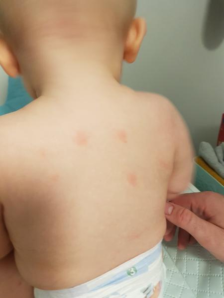 Aké biele vyrážky s červeným okolím sa robia synovi na chrbátiku?