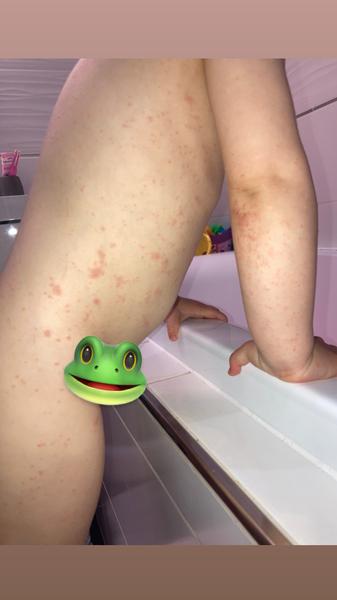 Čo sú to za vyrážky?