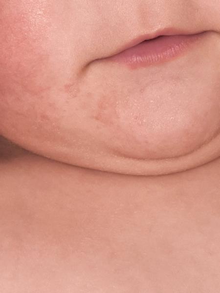 Vyrážky na tvári bábätka: Kedy navštíviť lekára?