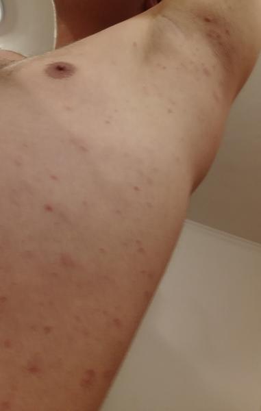 Z čoho môžem mať takéto vyrážky?