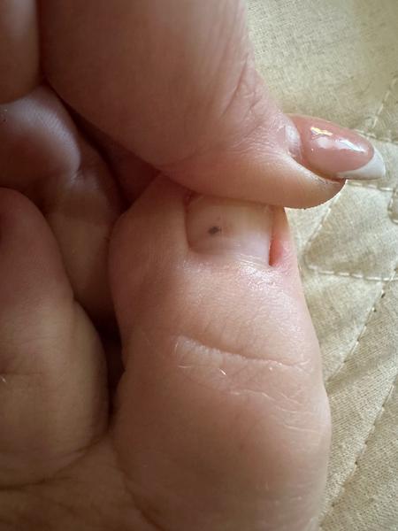 Necht a pod ním čierne. Môže to byť rakovina?