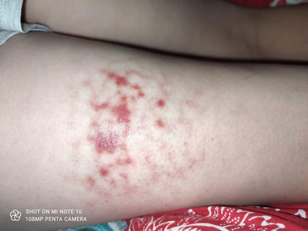 Aké fľaky sa mi to urobili na nohe pod zadkom?