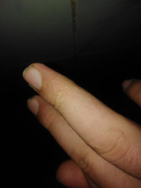 Akú vyrážku to mám na ruke?