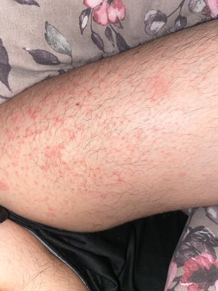 Čo spôsobuje vyrážky na tele a stehnách?