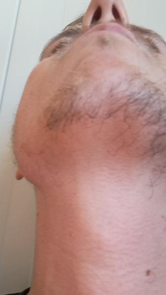 Príčiny nerovnomerného rastu fúzov na tvári