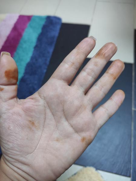 Z čoho mám oranžovohnedé fľaky na dlani?